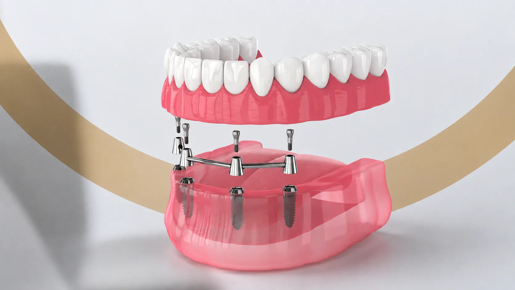 Reabilitare All-on-4 - punte fixă pe 4 implanturi, The Smile Lounge Constanța