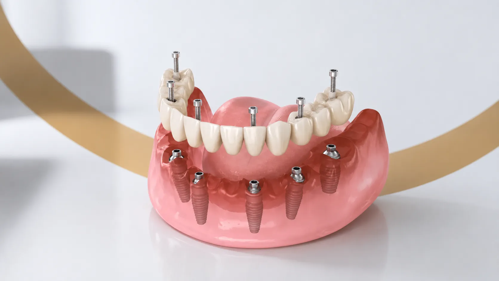 Reabilitare All-on-6 - arcadă fixă pe 6 implanturi, The Smile Lounge Constanța