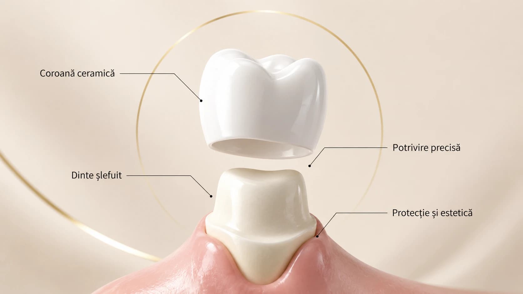 Componentele unei coroane dentare: coroană ceramică, dinte șlefuit, potrivire precisă