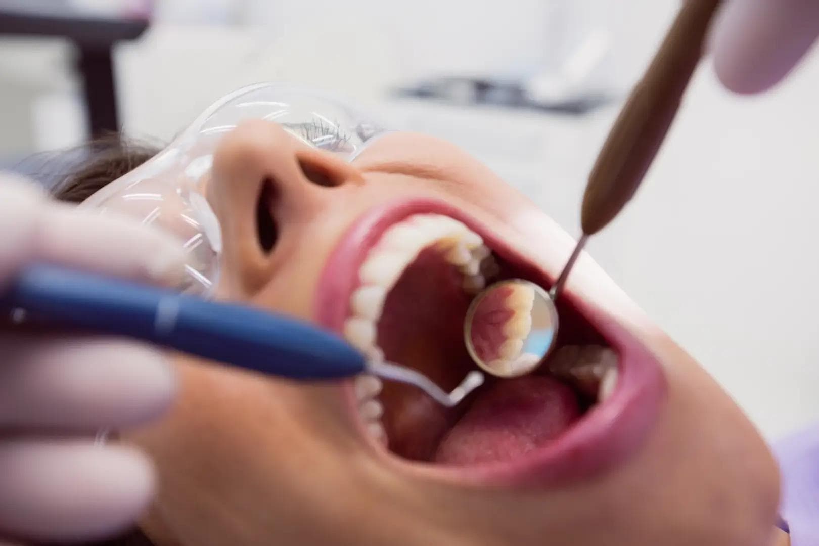 Ce este tartrul dentar și cum se formează | Smile Lounge