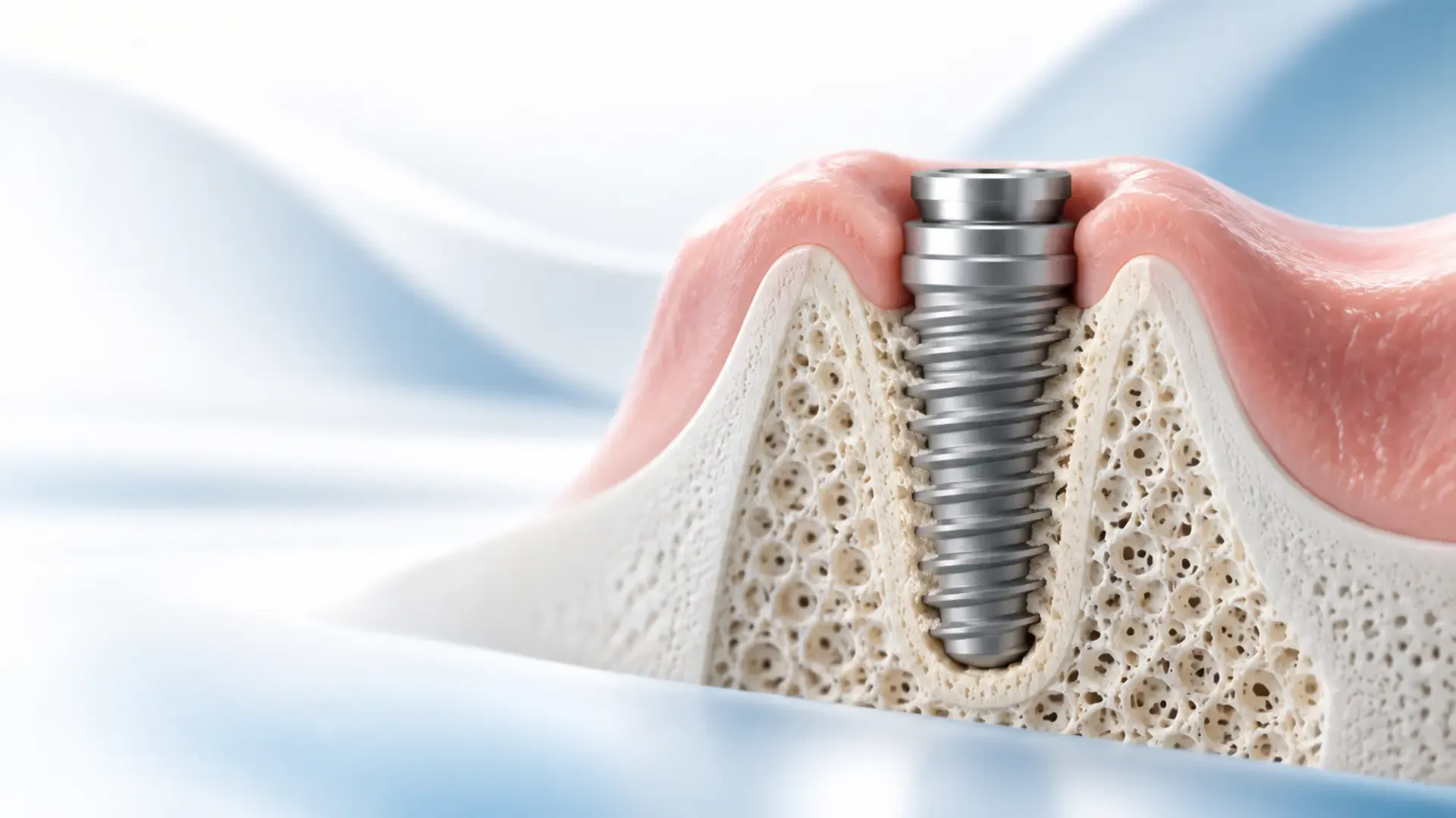 Cât durează vindecarea după implantul dentar?